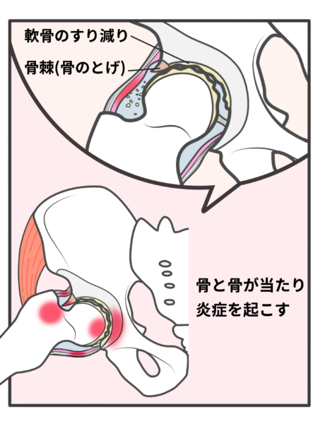 股関節のイラスト